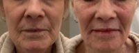 75 and up year old woman treated with Restylane Defyne
