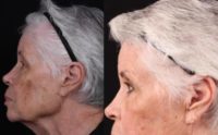 75 and up year old woman treated with CO2 Laser