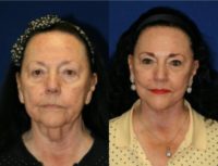 80 year old woman treated with Facelift