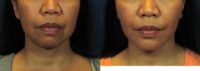 Chin Implant with Laser Facelift