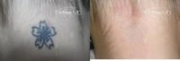 25-34 year old woman treated with Laser Tattoo Removal