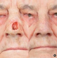 Man treated with Mohs Surgery