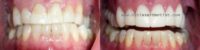 Person treated with Porcelain Veneers