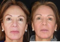 55-64 year old woman treated with Non Surgical Face Lift, AmayaPeel