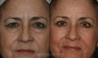55-64 year old woman treated with Lower Eyelid/Blepharoplasty Surgery