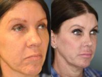 35-44 year old woman treated with Rhinoplasty