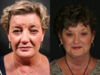 Quick Lift and Blepharoplasty Before and After