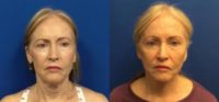 71 year old female who had a face/neck lift.
