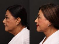 62 F treated with FaceTite and liposuction to neck