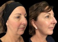 45-54 year old woman after Mini Facelift and Blepharoplasty (Upper Eyelid Surgery)
