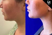 25-34 year old man treated with Chin Liposuction