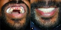 Man treated with Dental Crown