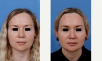 Woman in her 30s treated with Revision Rhinoplasty
