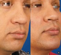 Man treated with Facial Fat Transfer