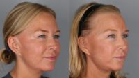45-54 year old woman treated with Facelift Revision, Neck Lift, Brow Lift, Facial Fat Transfer