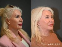 65 year old woman treated with Neck Lift
