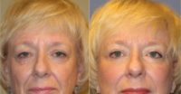 65-74 year old woman treated with Brow Lift