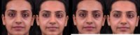 25-34 year old woman treated with Eye Bags Treatment