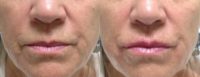 65 year old woman treated with Juvederm
