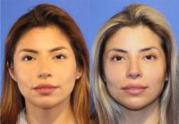 35-44 year old woman treated with upper blepharoplasty and Botox