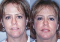 55-64 year old woman treated with FaceTite