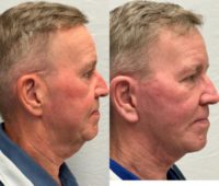 65-74 year old man treated with Deep Plane Facelift, Neck Lift