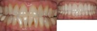 65-74 year old woman treated with Smile Makeover