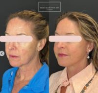 Woman treated with Lower Facelift