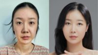 35-44 year old woman treated with Mini Facelift, Rhinoplasty