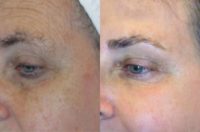 45-54 year old woman treated with Fraxel Laser