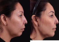 35-44 year old woman treated with Injectable Fillers in the Chin and Ultherapy