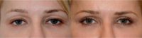 50 y.o. woman with upper lid skin fold, treated with upper eyelid tuck (blepharoplasty)