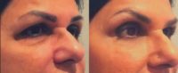 55-64 year old woman treated with Non Surgical Face Lift