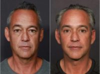 55-64 year old man treated with Deep Plane Facelift