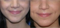22 year old woman has undergone cheek dimple creation