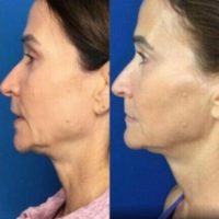 Woman treated with Sofwave