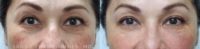 55-64 year old woman treated with Undereye Injectable Fillers