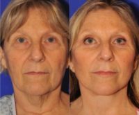 55-64 year old woman treated with Facelift, Upper and Lower Lid Blepharoplasty