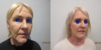 55-64 year old woman treated with Lower Facelift