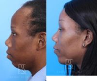 25-34 year old transgender woman treated with Facial Feminization Surgery, Transgender Facial Feminization Surgery, Facial Fat T