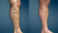 Extensive varicose veins treated with EVLT and micro-phlebectomy
