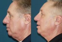65-74 year old man treated with Agnes and Scarlet RF skin rejuvenation