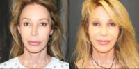 Woman treated with Revision Rhinoplasty