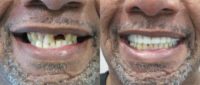 55-64 year old man treated with All-on-4 Dental Implants