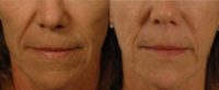 Los Angeles Sculptra Injections