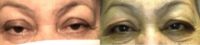 Woman treated with Ptosis Surgery