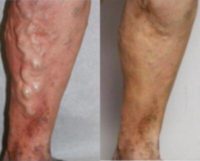 55-64 year old man treated with Vein Treatment