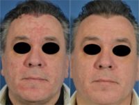 45-54 year old man treated with Rosacea Treatment