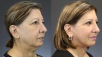 64 year old woman treated with facelift and eyelid surgery