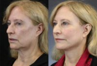 65 year old woman treated with facelift